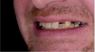 Dental Implant Before.