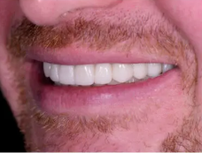 Dental Implant After