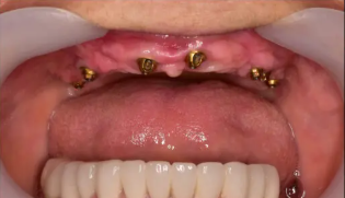 Dental Implant Before.