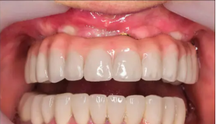 Dental Implant After
