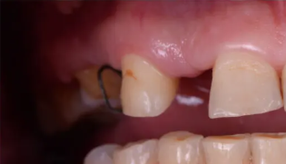 Dental Implant Before.