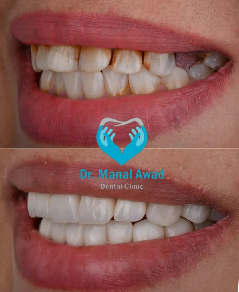 Cosmatic dentistry In Jordan 4