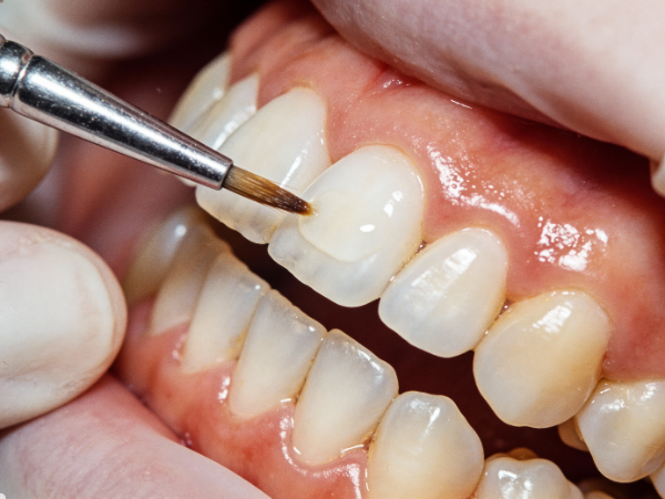 Dental Bridges Treatment Amman