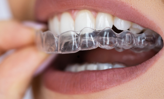 Wear Clear Aligners