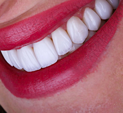Dental Veneers treatment 4